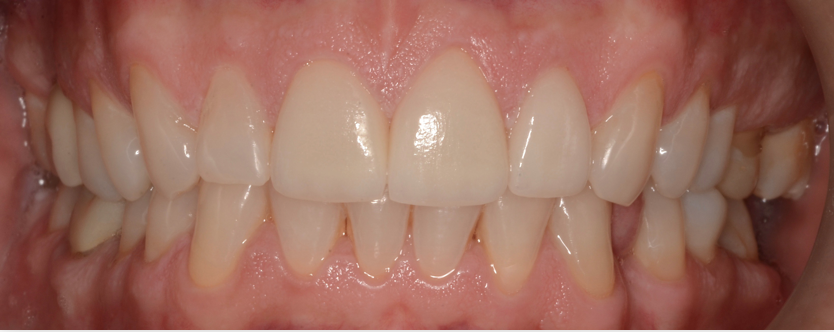 Rehabilitation with esthetic veneers (upper incisors)